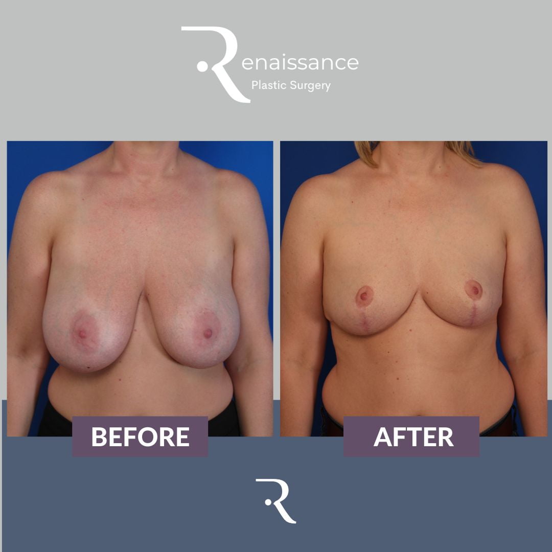 Breast Reduction Before and After 3 - Front