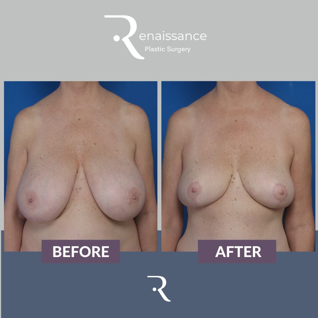 Breast Reduction Before and After 4 - Front