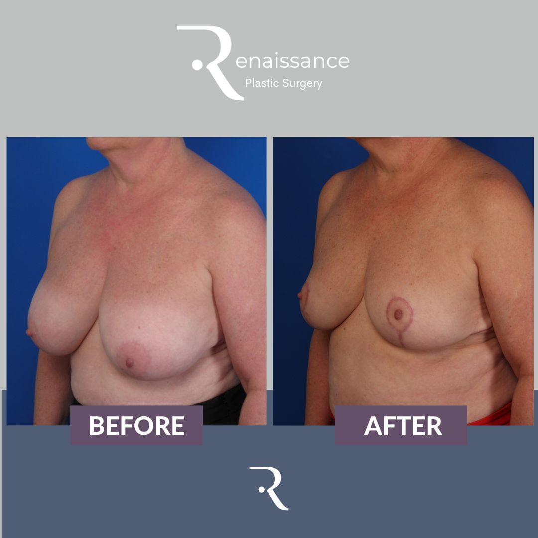 Breast Reduction Before and After 6 - Side