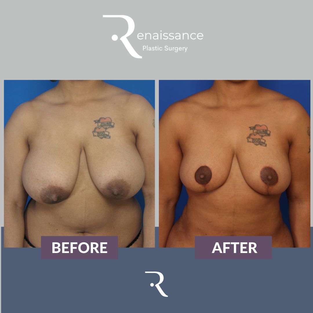 Breast Reduction Before and After 8 - Front