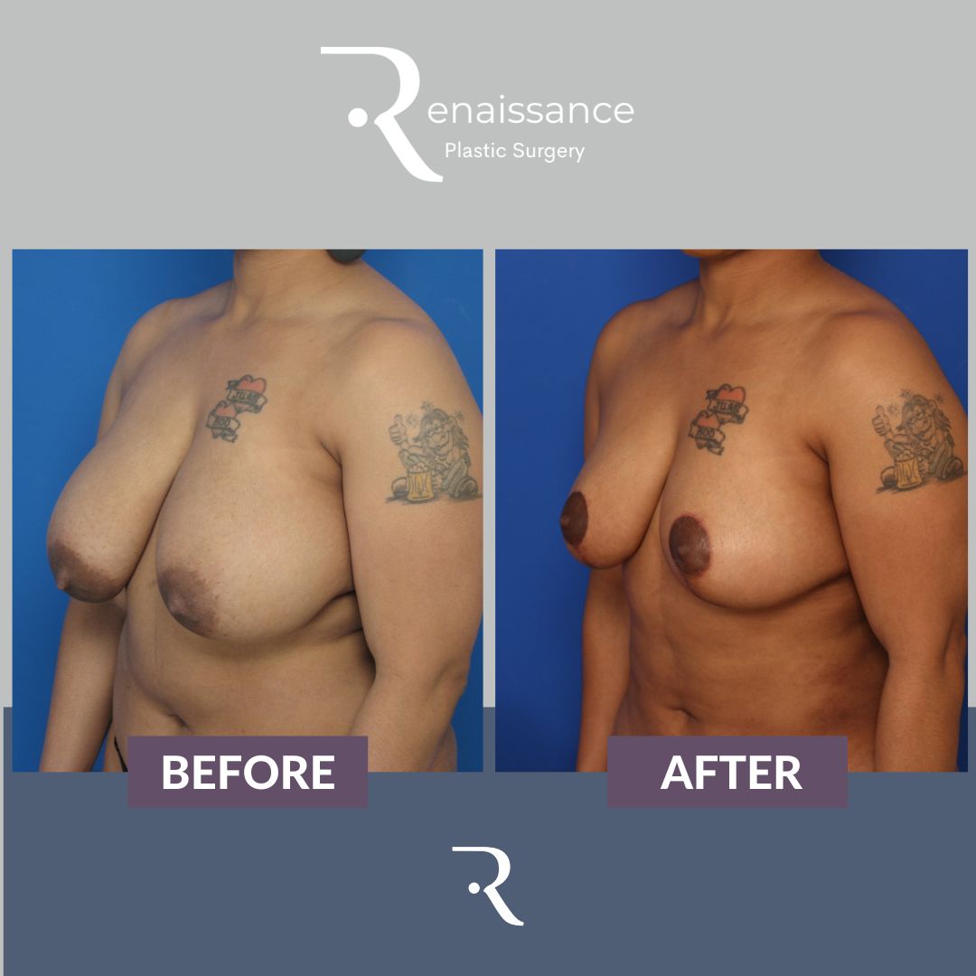 Breast Reduction Before and After 8 - Side