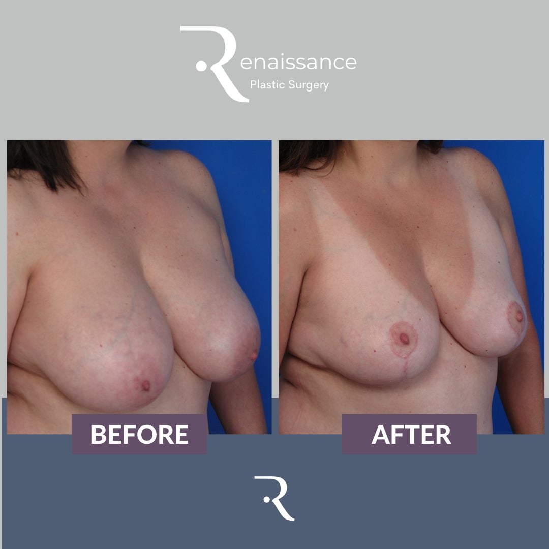 Breast Reduction Before and After 9 - Side