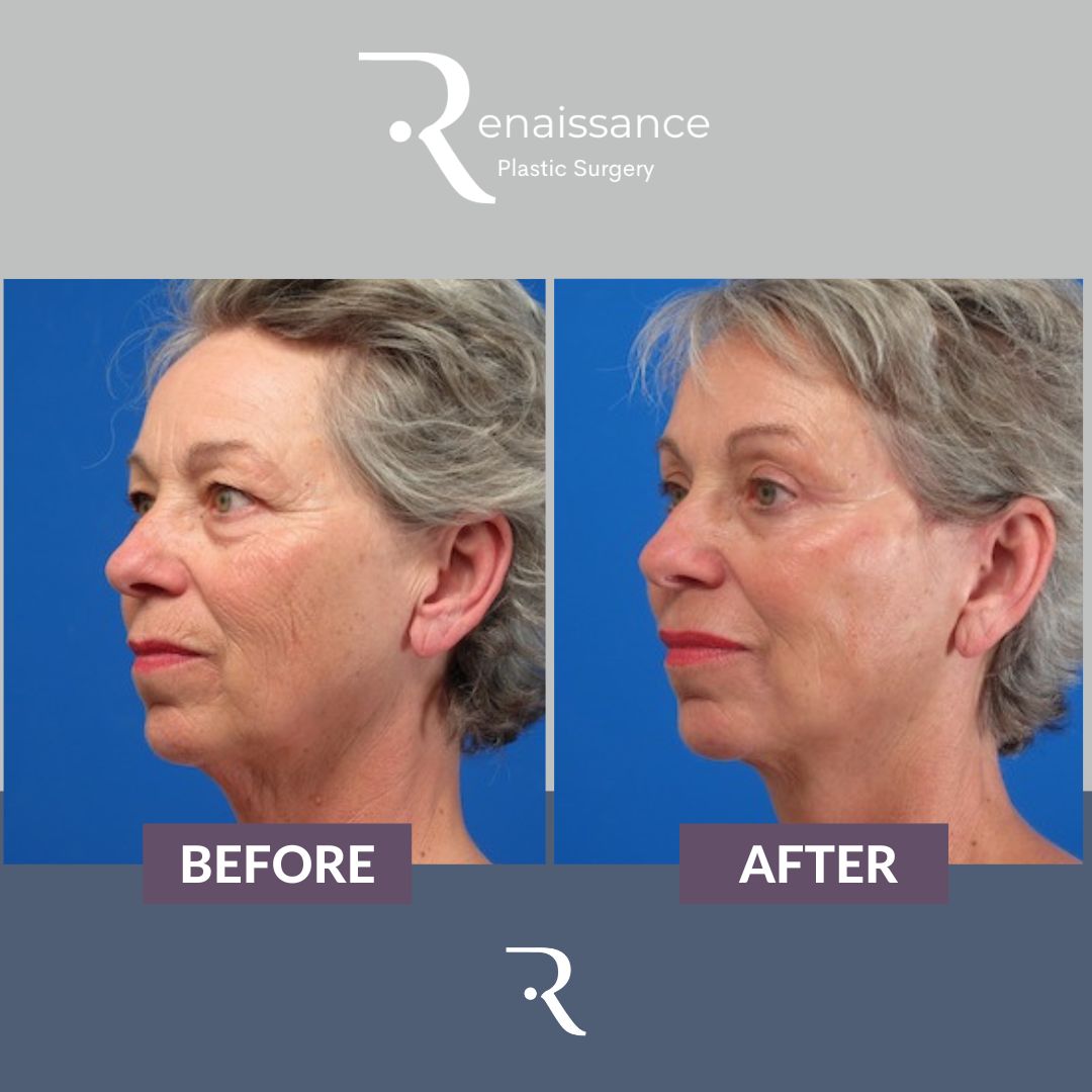 Facelift Before and After 1 - Side