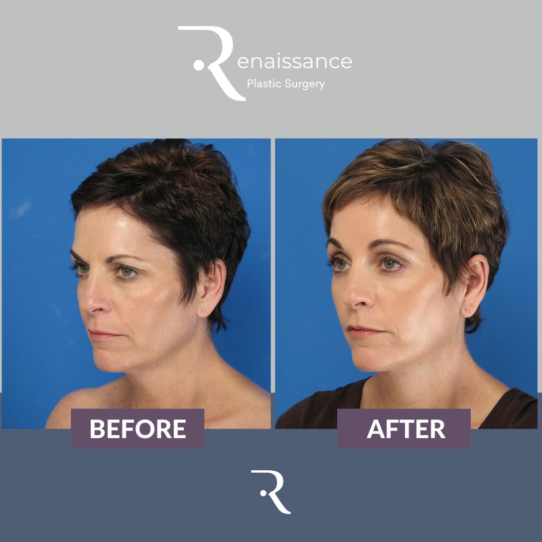 Facelift Before and After 3 - Side