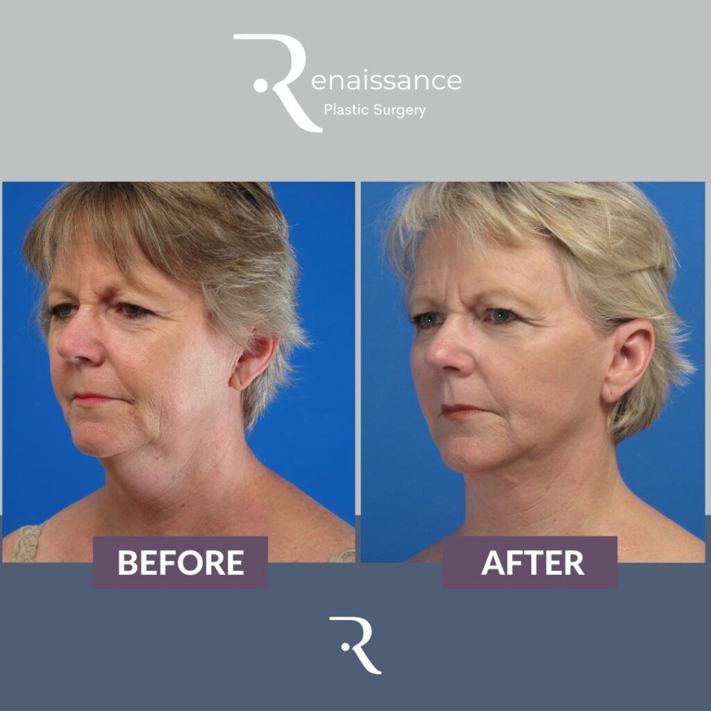 Facelift Before and After 4 - Front