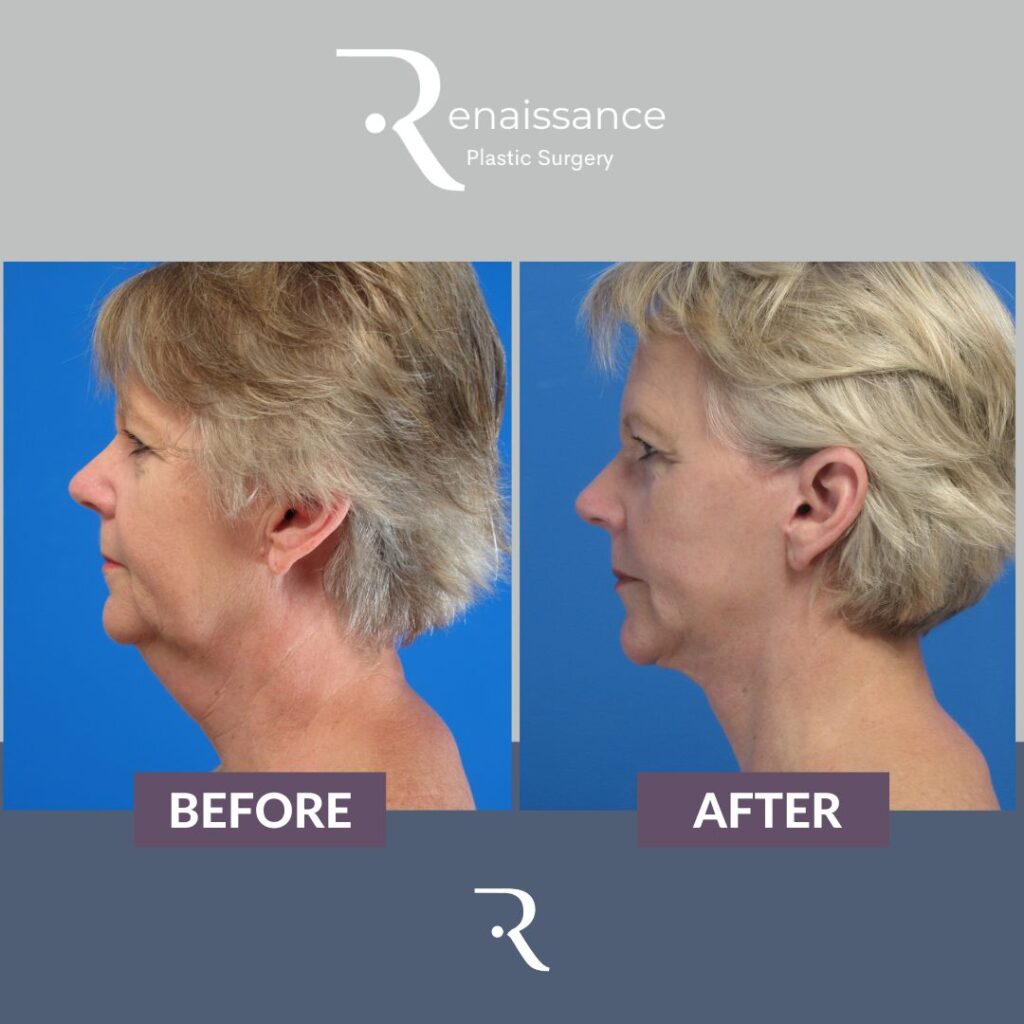 Facelift Before and After 4 - Side