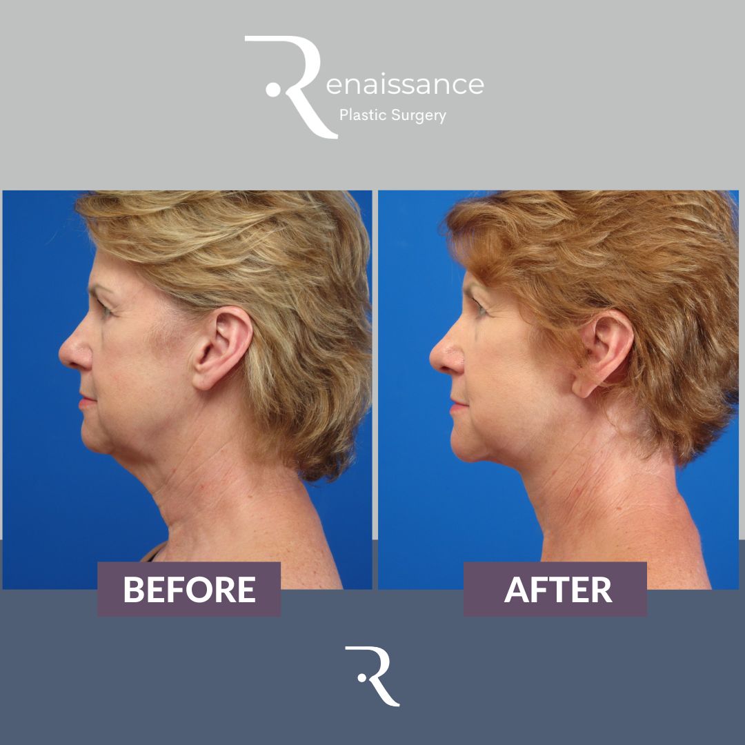 Facelift Before and After 7 - Side