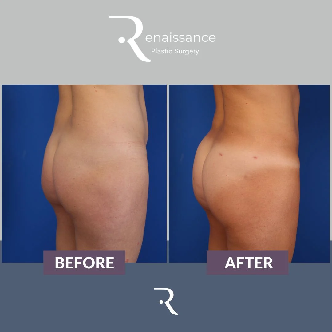 Fat Injections Buttocks Before and After