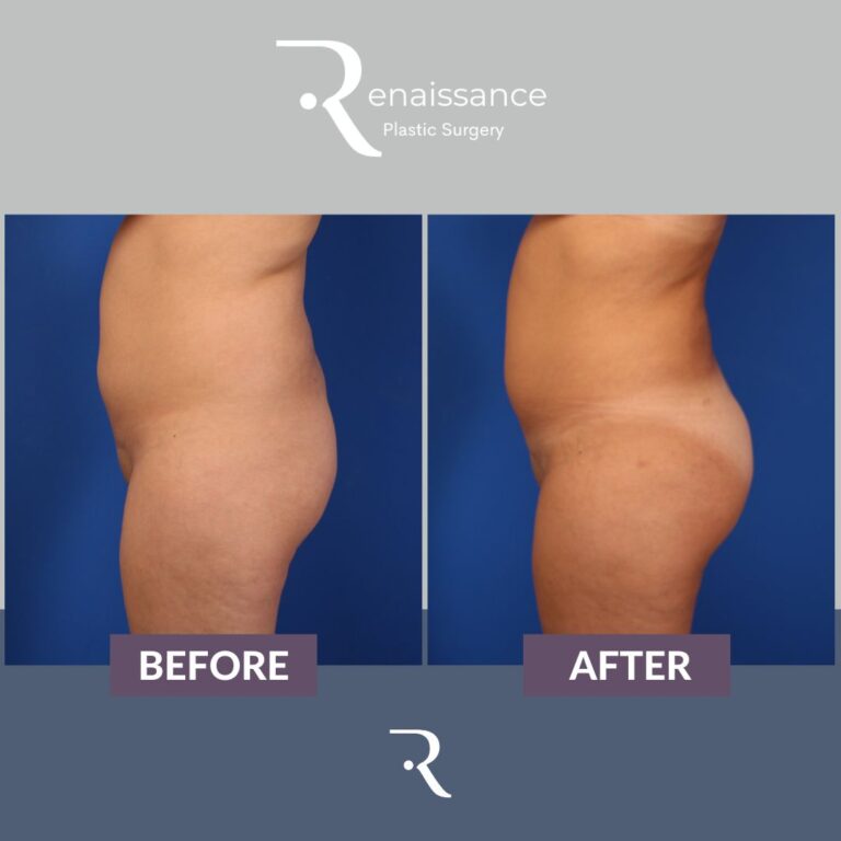 Fat Injections Buttocks Before and After - Renaissance Plastic Surgery