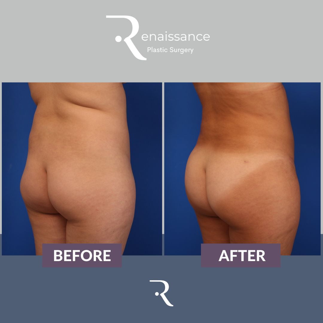 Fat Injections Buttocks Before and After 2 - Right