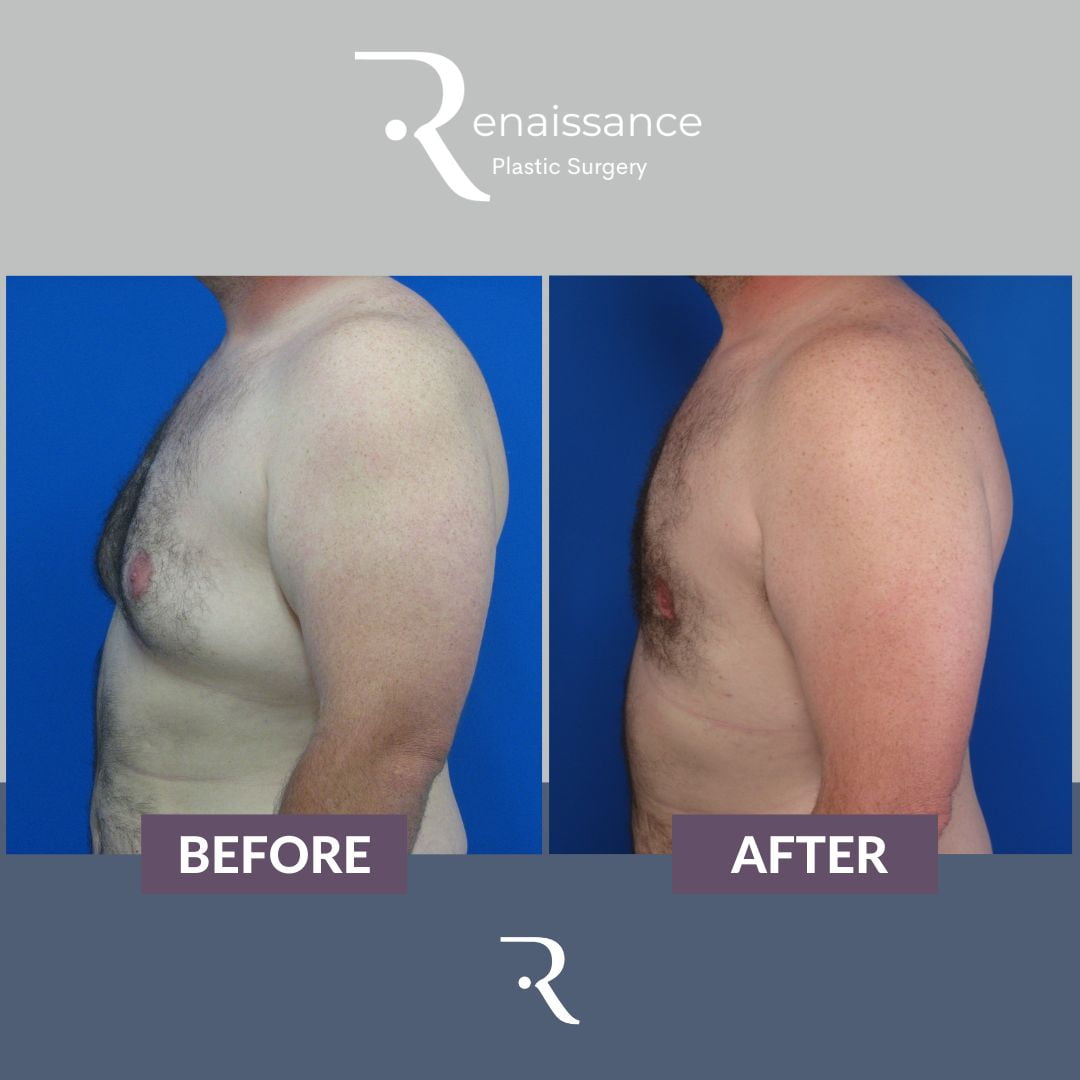 Gynecomastia Before and After 1 - Side