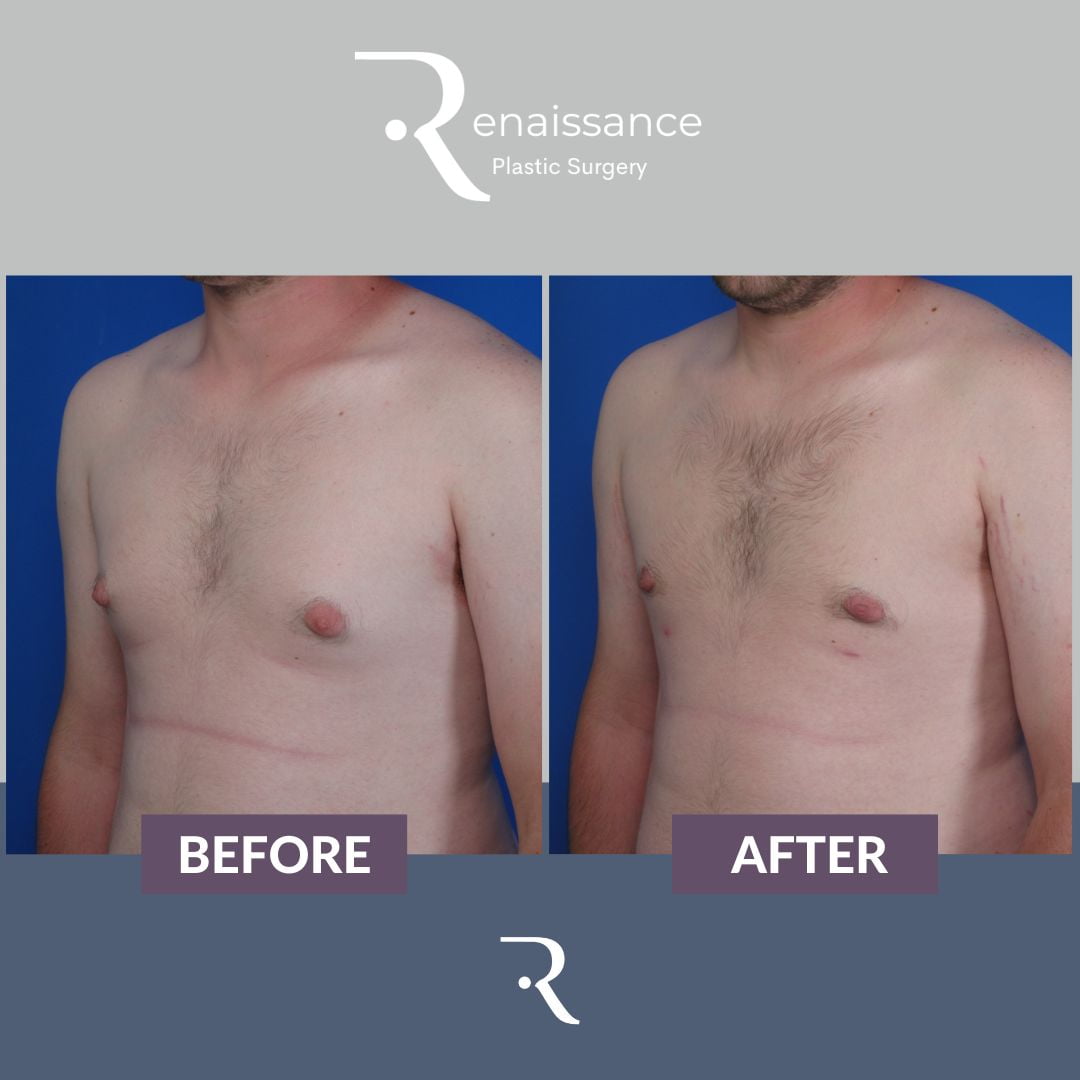 Gynecomastia Before and After 2 - Front