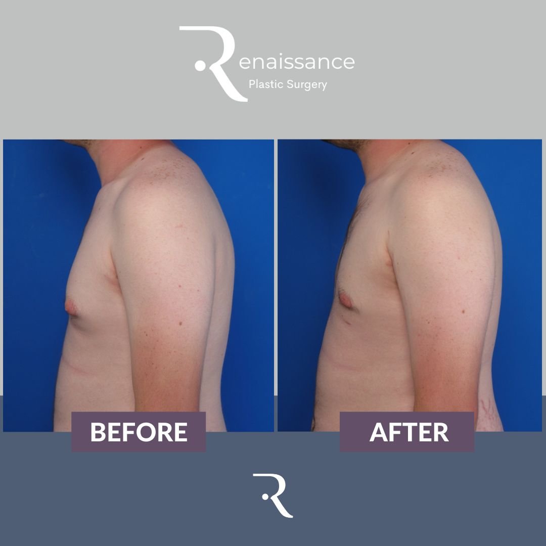 Gynecomastia Before and After 2 - Side