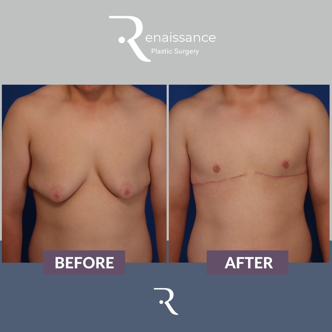 Gynecomastia Before and After 3 - Front