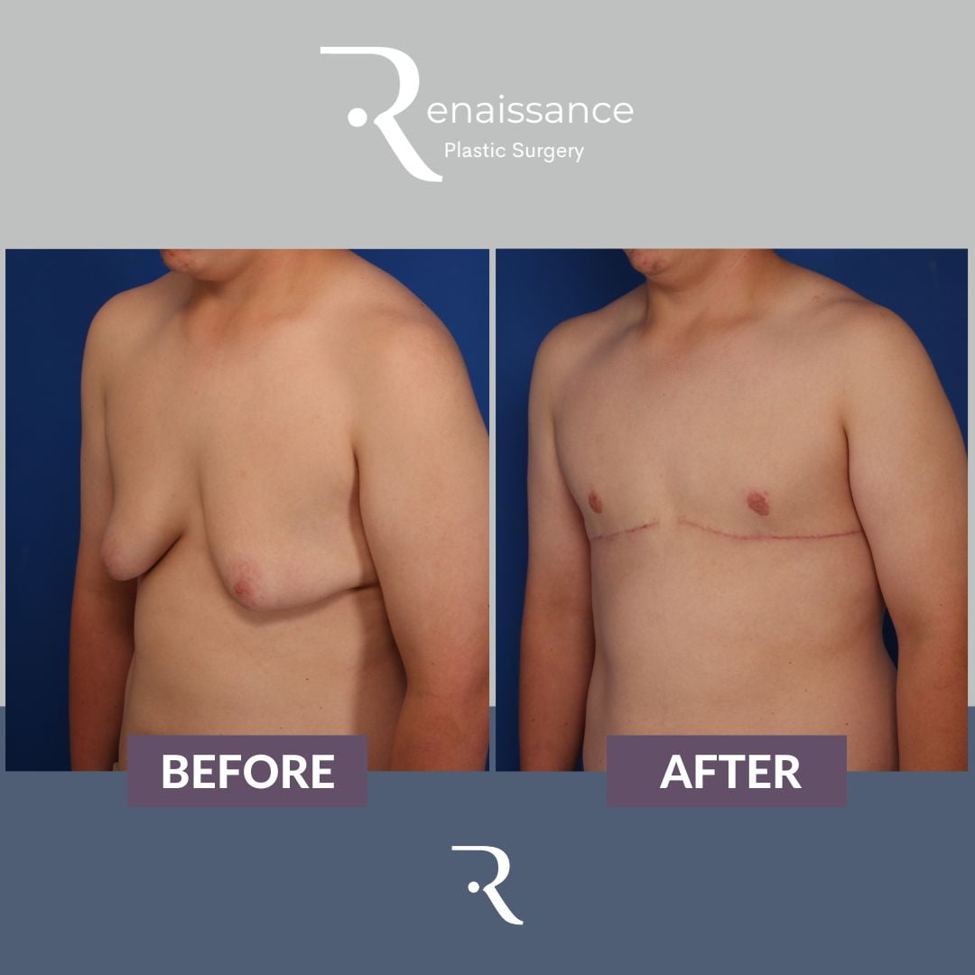Gynecomastia Before and After 3 - Side
