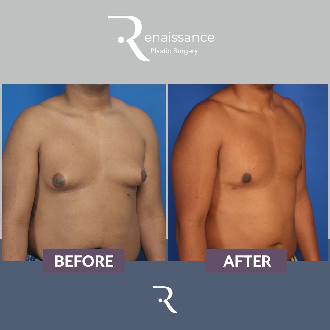 Gynecomastia Before and After 4 - Side