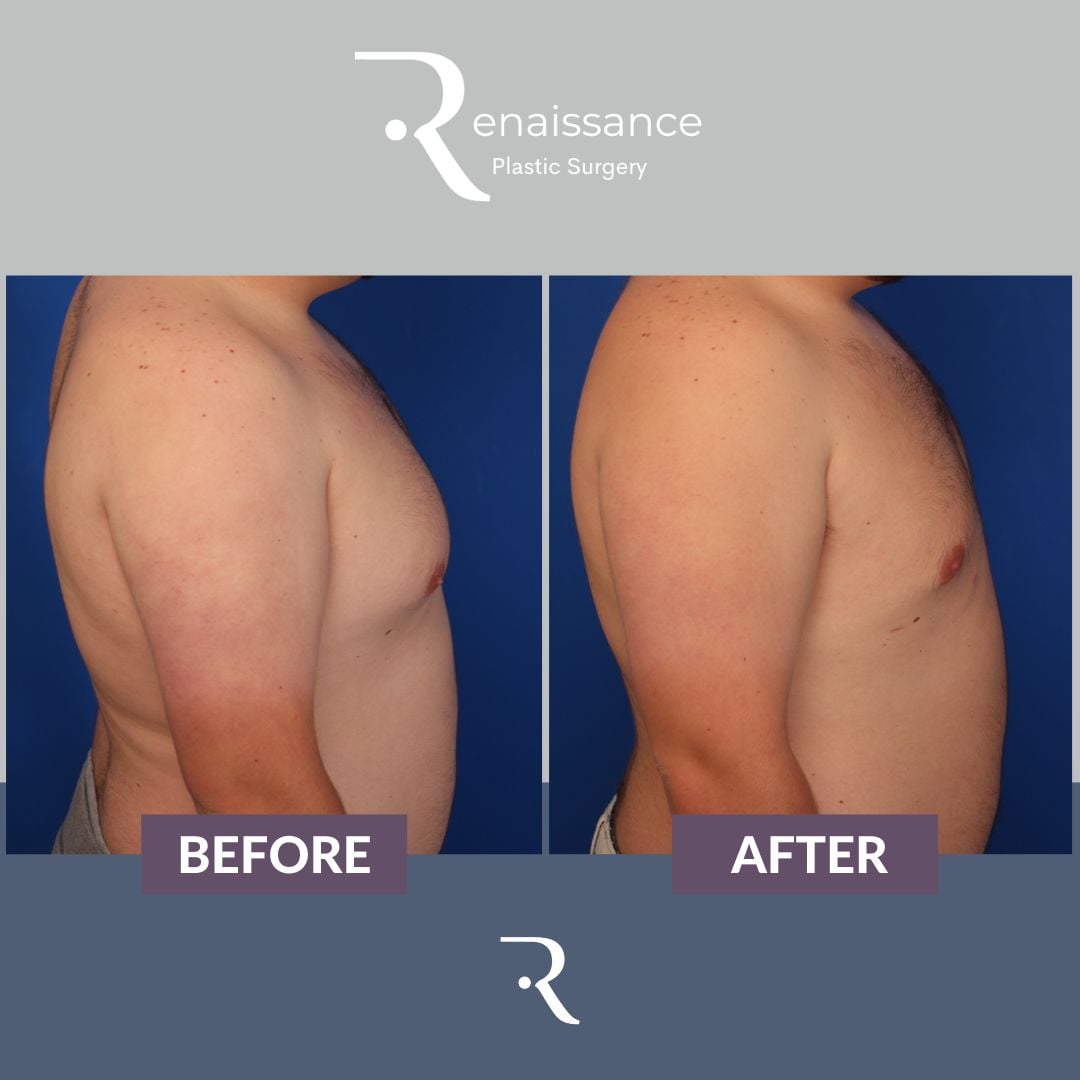 Gynecomastia Before and After 7 - Side