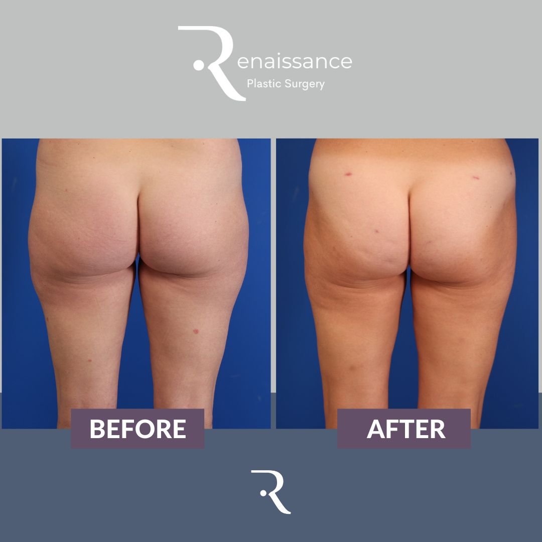 Liposuction Before and After 1 - Back