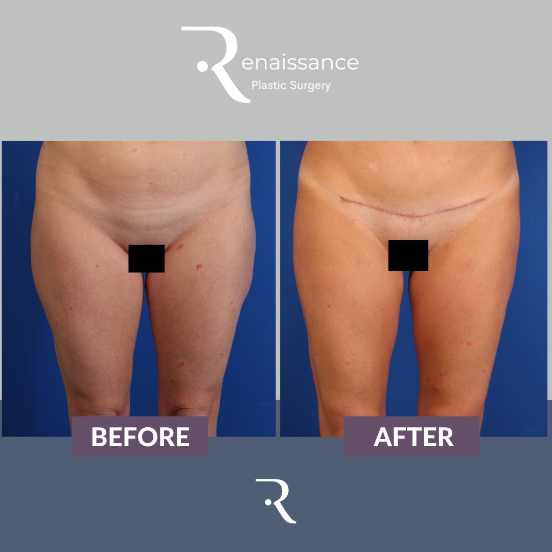 Liposuction Before and After 1 - Front