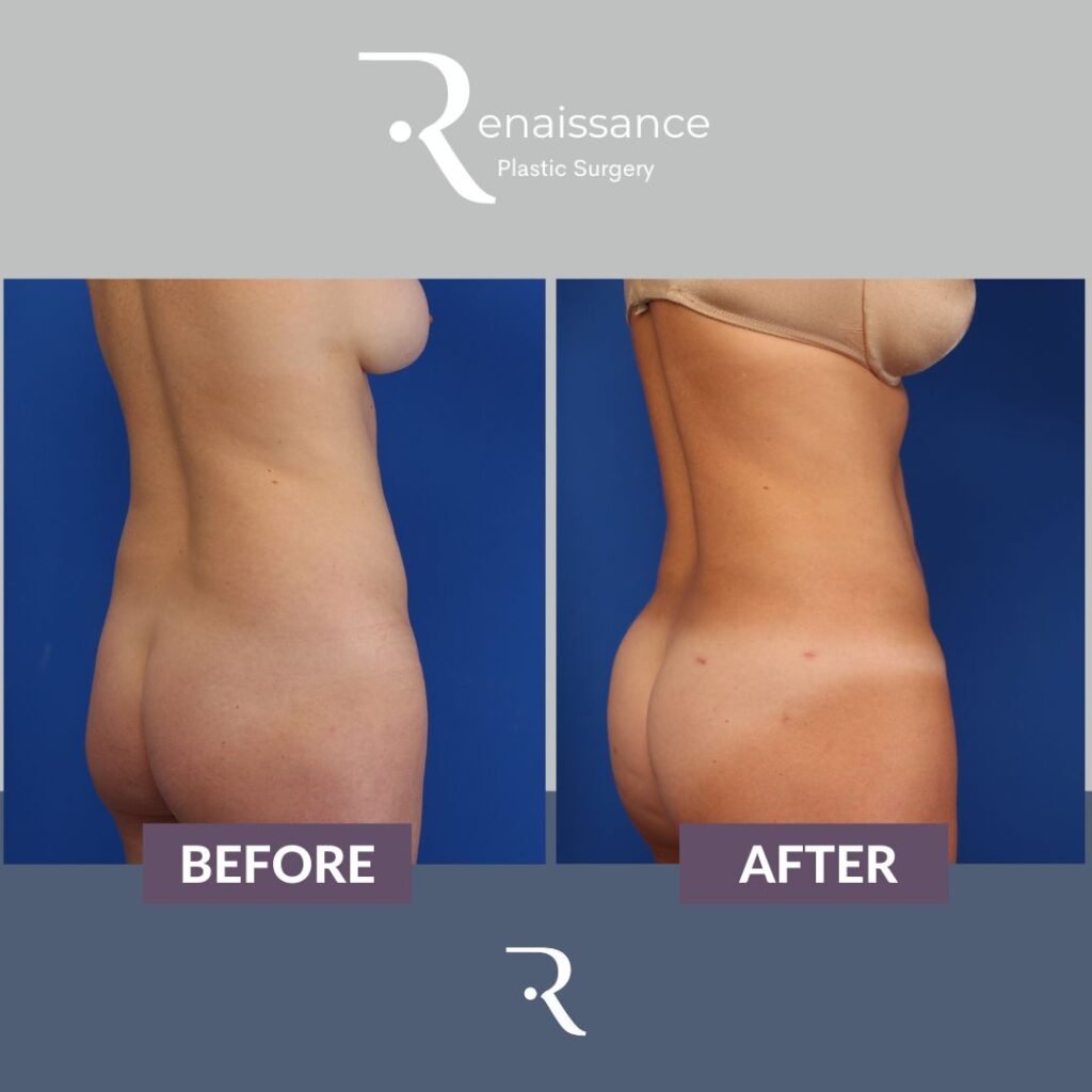 Liposuction Before and After 1 - Upper Back Side