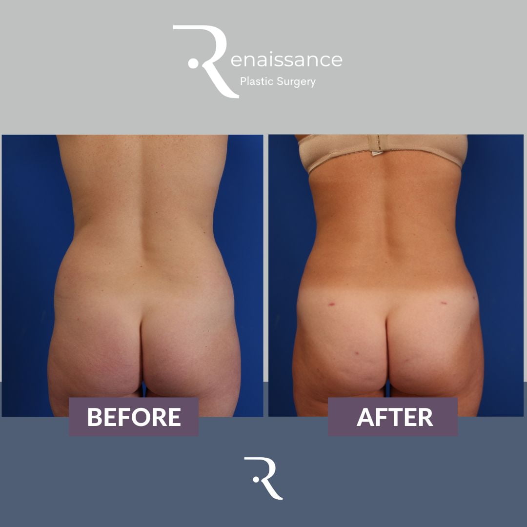 Liposuction Before and After 1 - Upper Back
