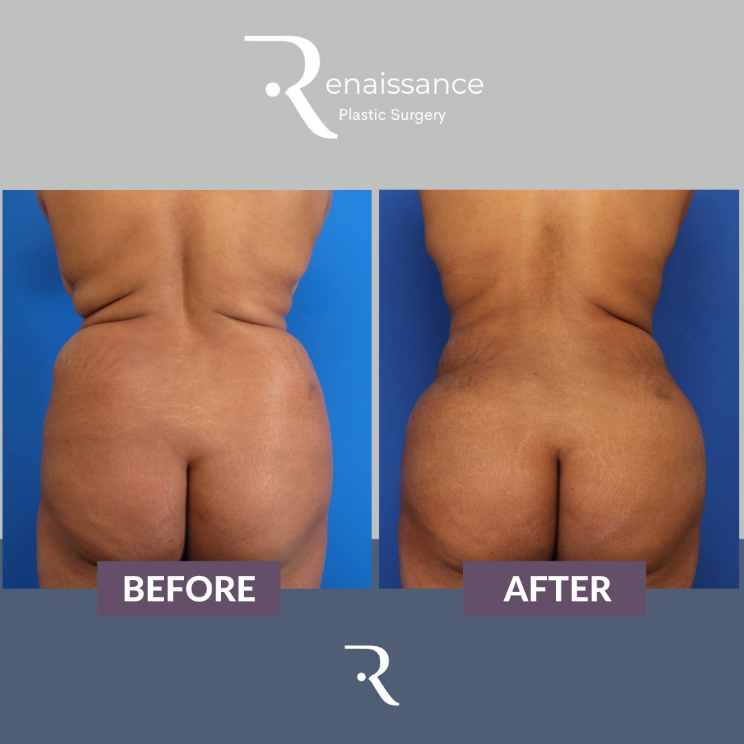 Liposuction Before and After 2 - Back