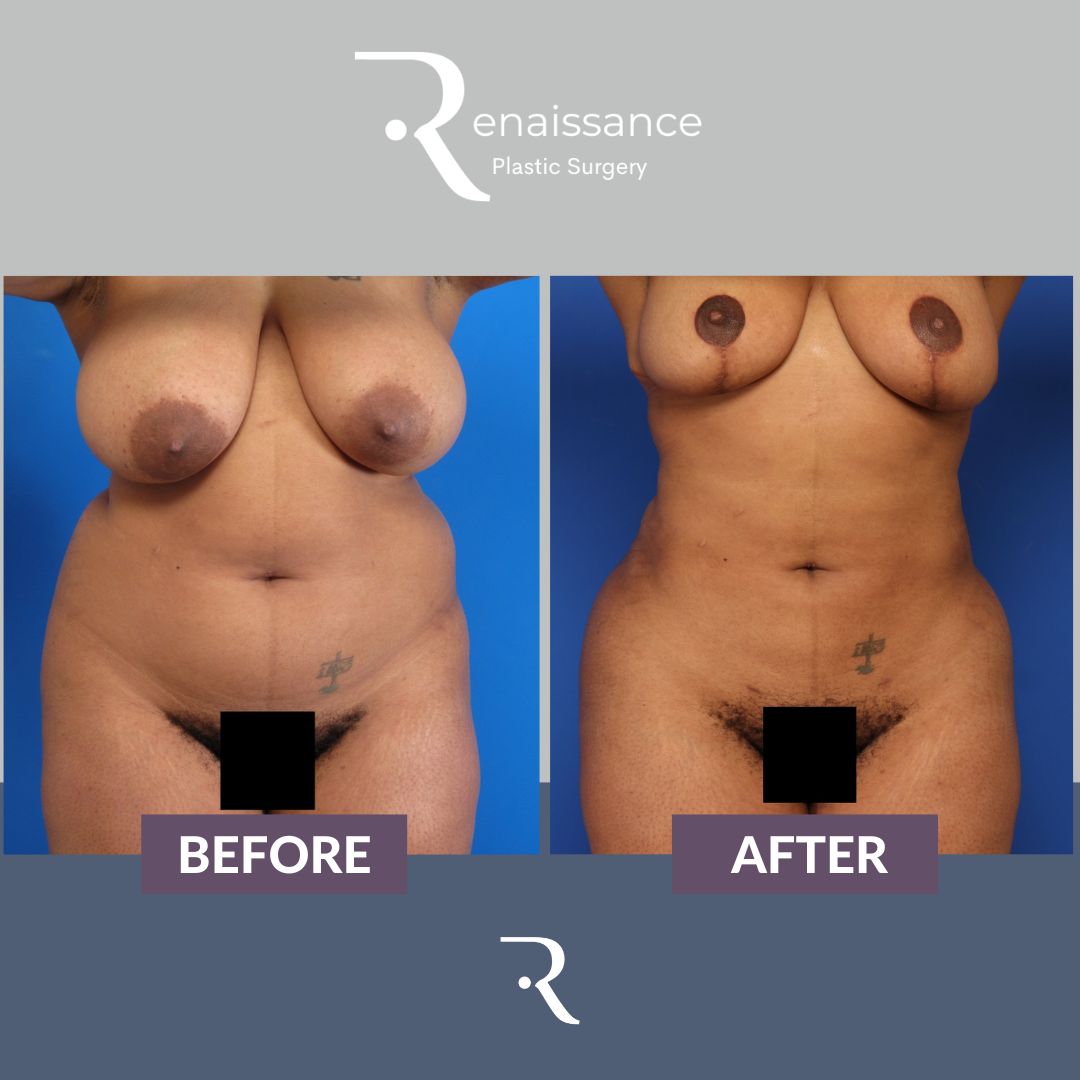 Liposuction Before and After 2 - Front