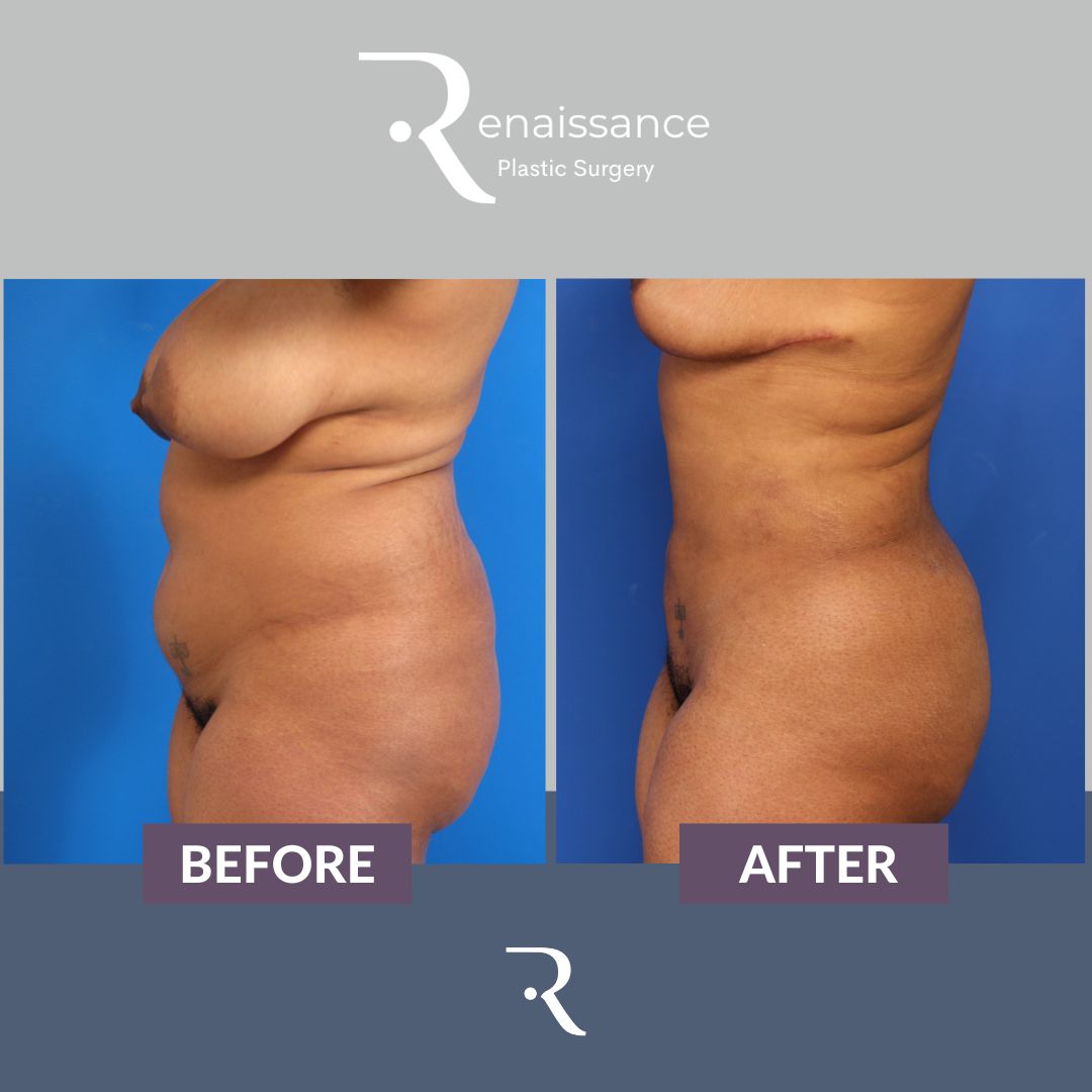 Liposuction Before and After 2 - Side
