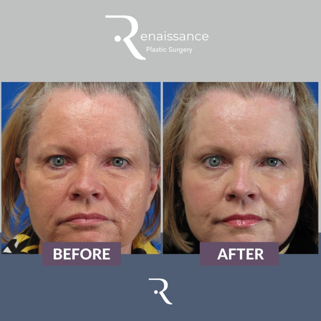 Phenol Peel Before and After Renaissance Plastic Surgery