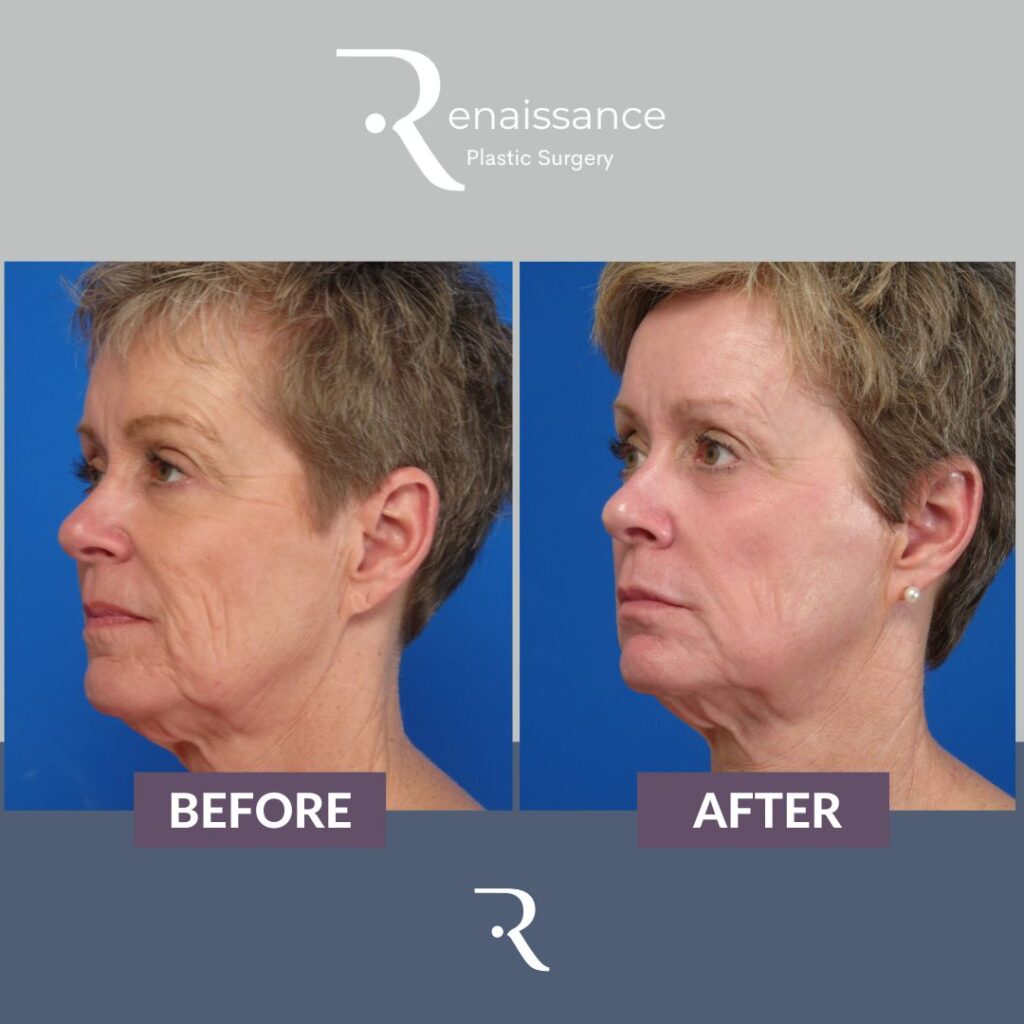 Phenol Peel Before and After Renaissance Plastic Surgery