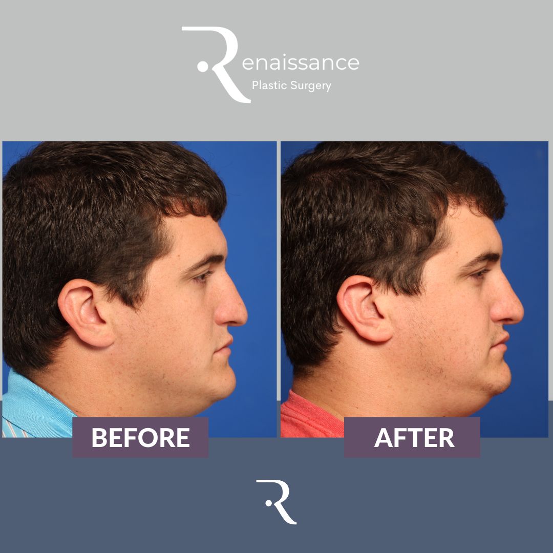 Rhinoplasty Before and After 1 - Side