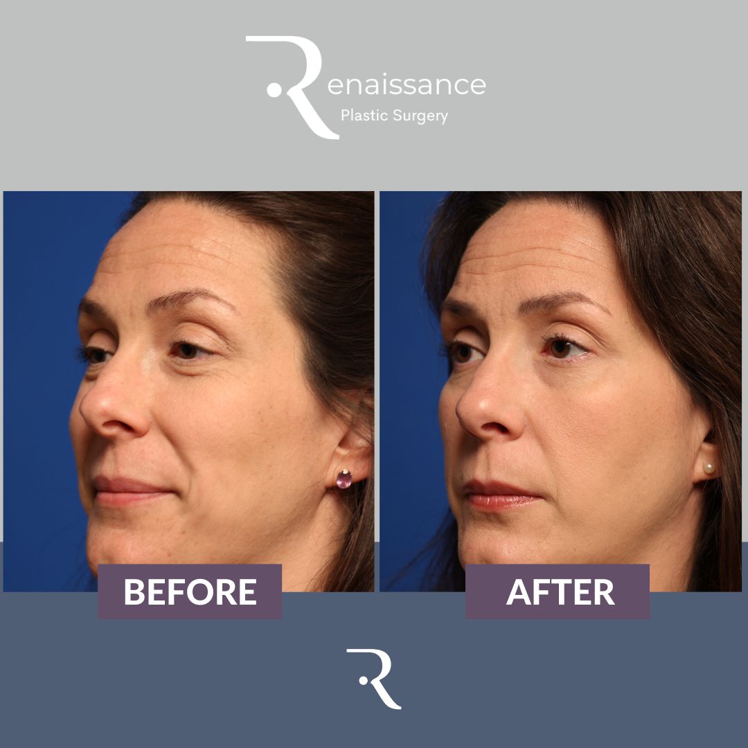 Rhinoplasty Before and After 2 - Side