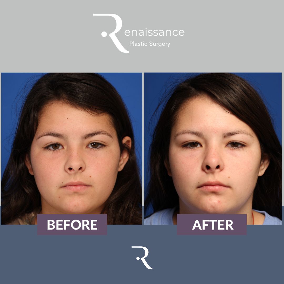 Rhinoplasty Before and After 3 - Front