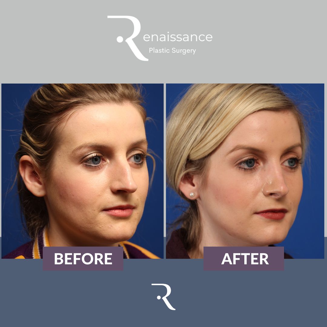 Rhinoplasty Before and After 4 - Front