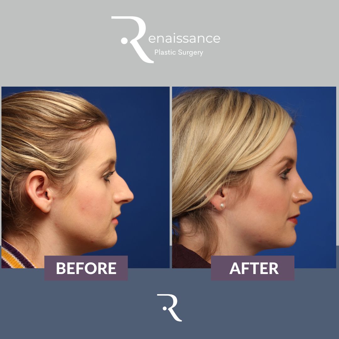 Rhinoplasty Before and After 4 - Side