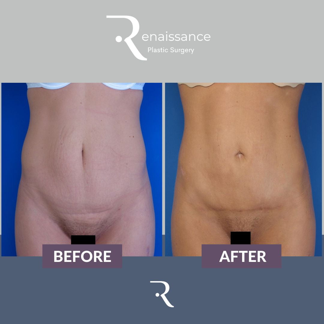 Tummy Tuck Before and After 1 - Front