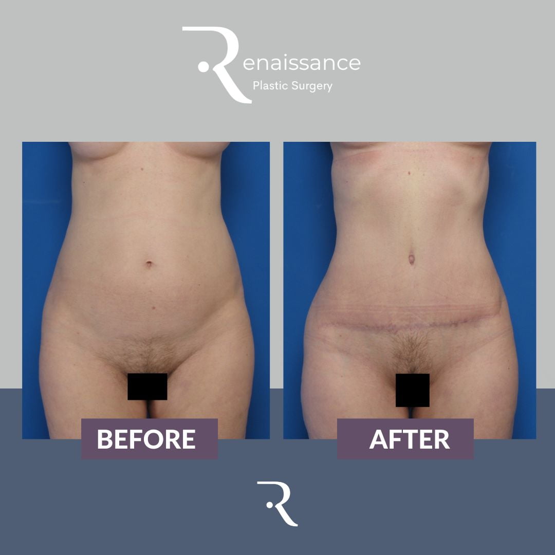 Tummy Tuck Before and After 11 - Front