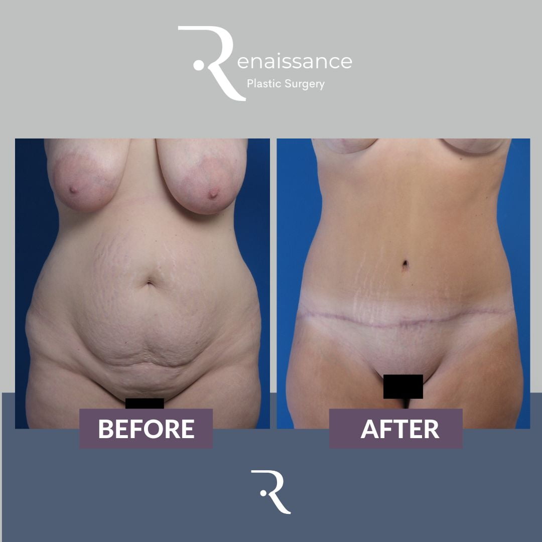 Tummy Tuck Before and After 12 - Front