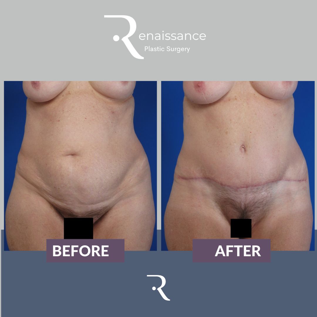 Tummy Tuck Before and After 13 - Front