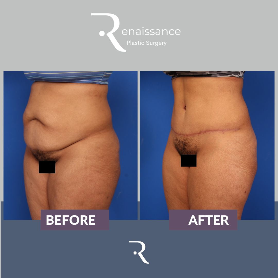Tummy Tuck Before and After 14 - Side