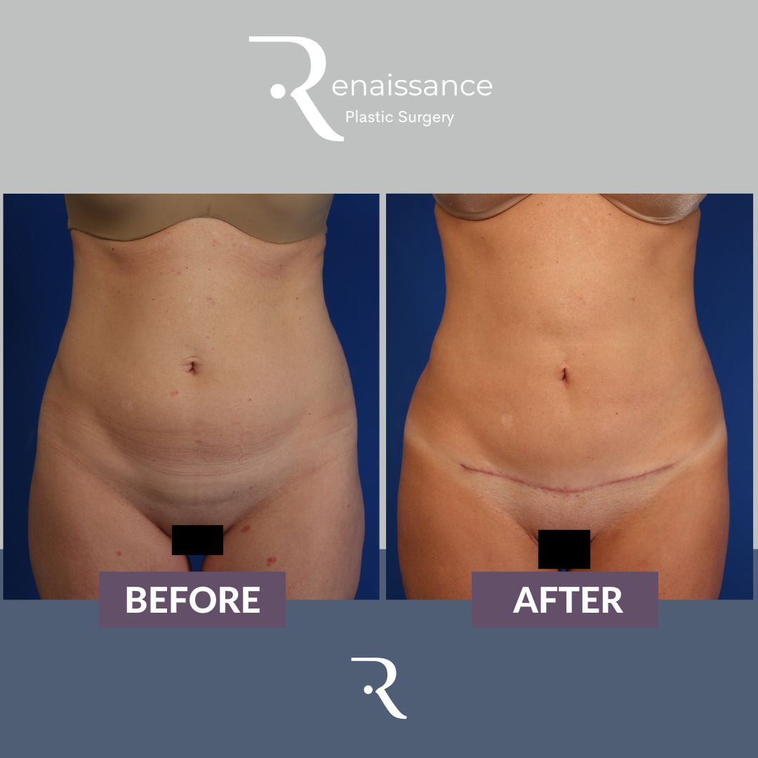 Tummy Tuck Before and After 15 - Front