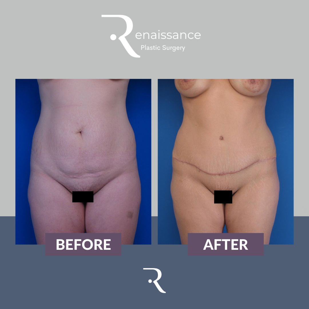 Tummy Tuck Before and After 2 - Front