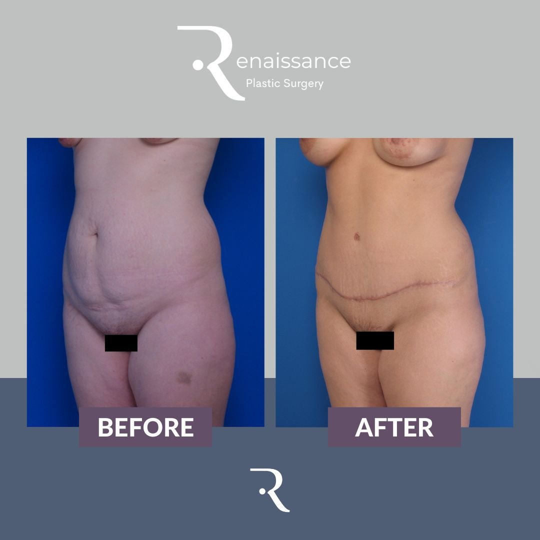 Tummy Tuck Before and After 2 - Side