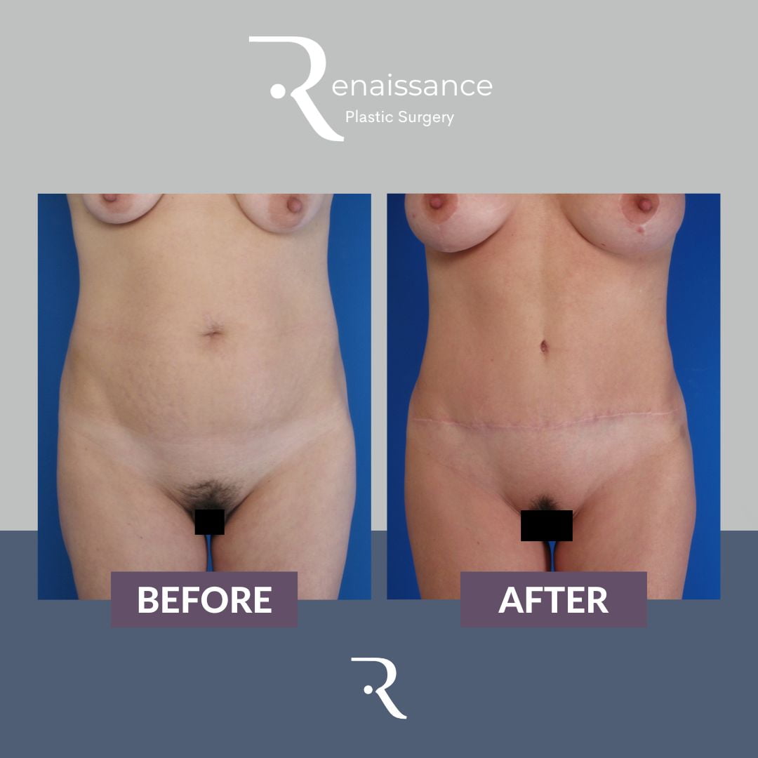 Tummy Tuck Before and After 4 - Front