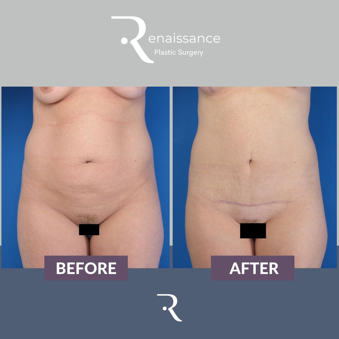 Tummy Tuck Before and After 5 - Front