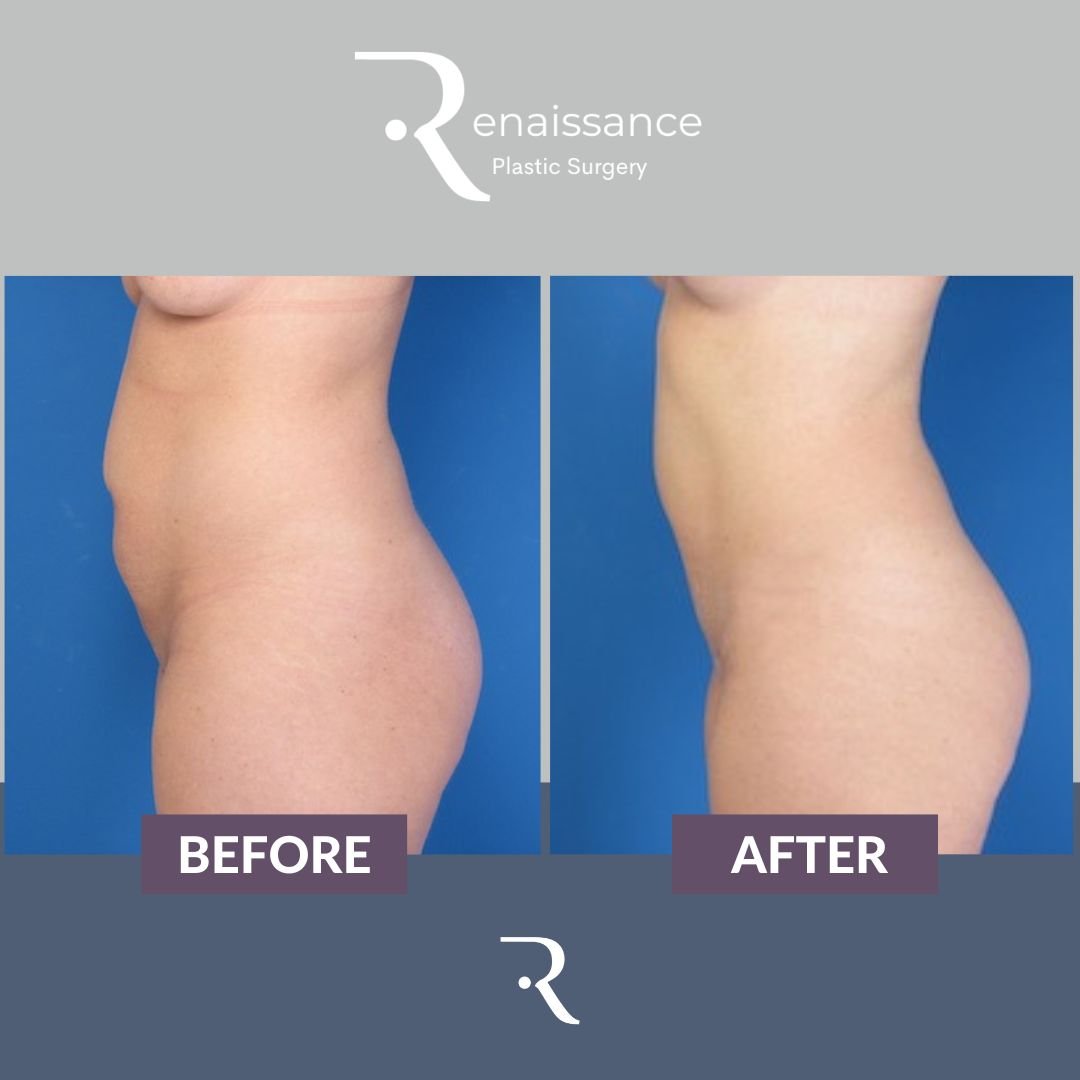 Tummy Tuck Before and After 5 - Side