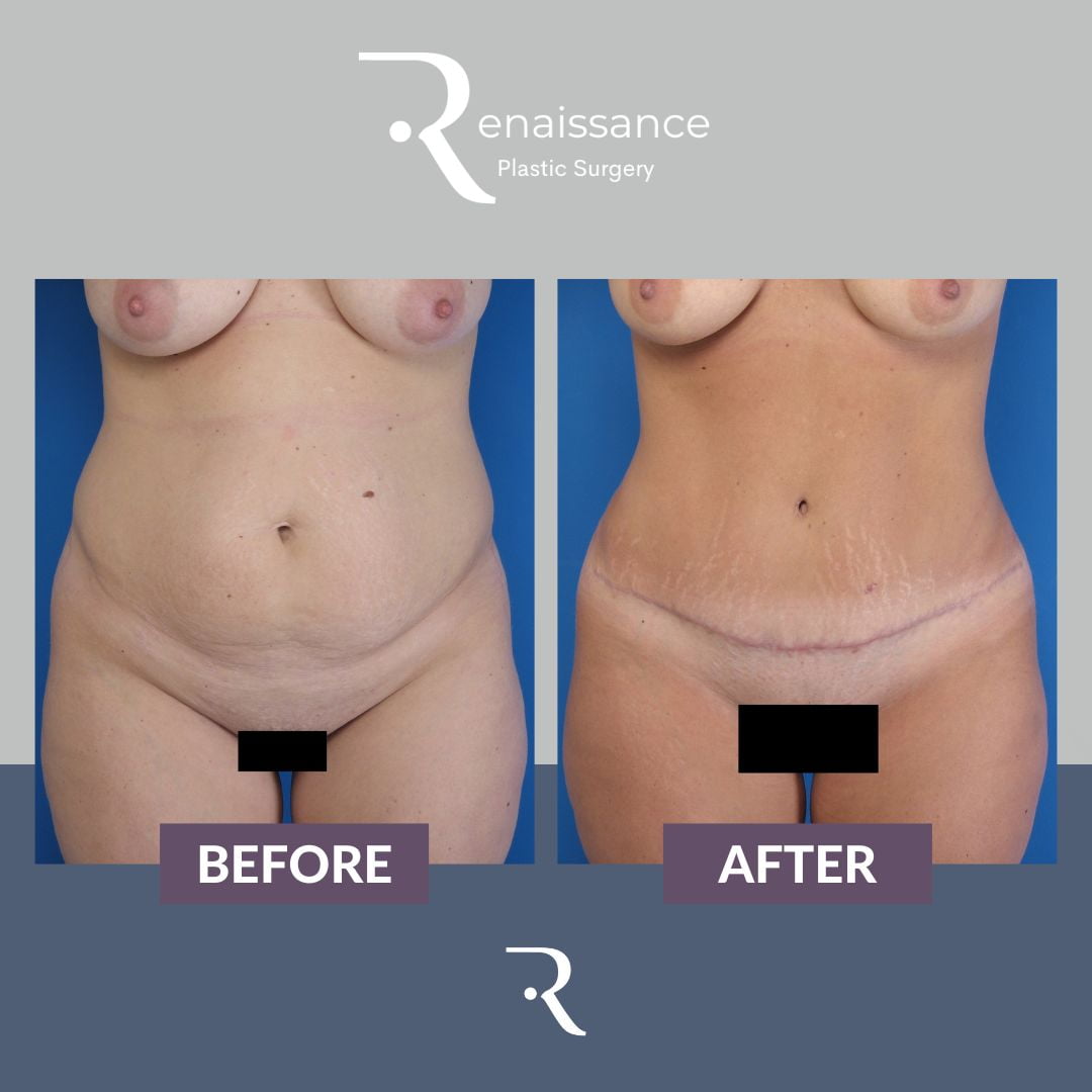 Tummy Tuck Before and After 6 - Front