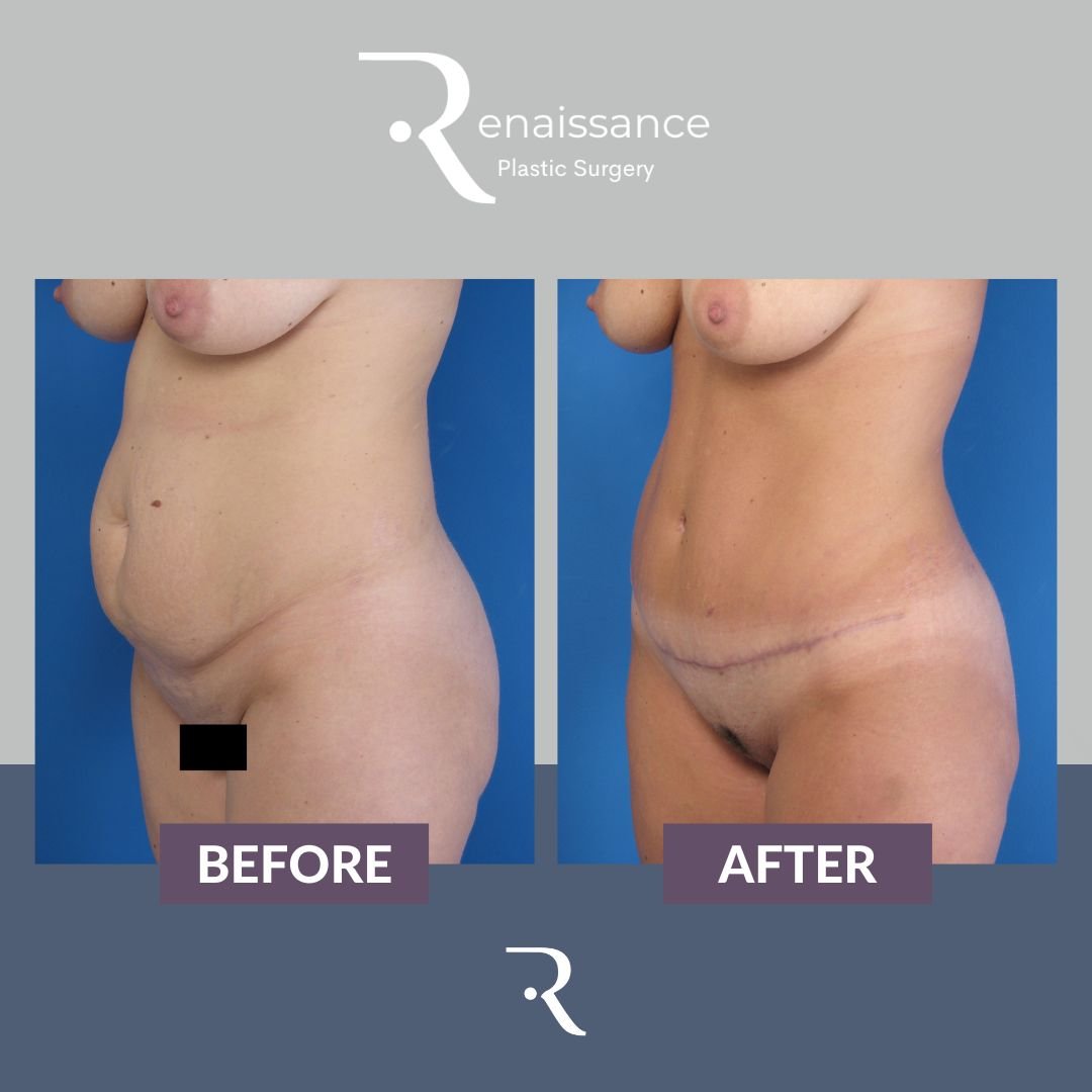 Tummy Tuck Before and After 6 - Side
