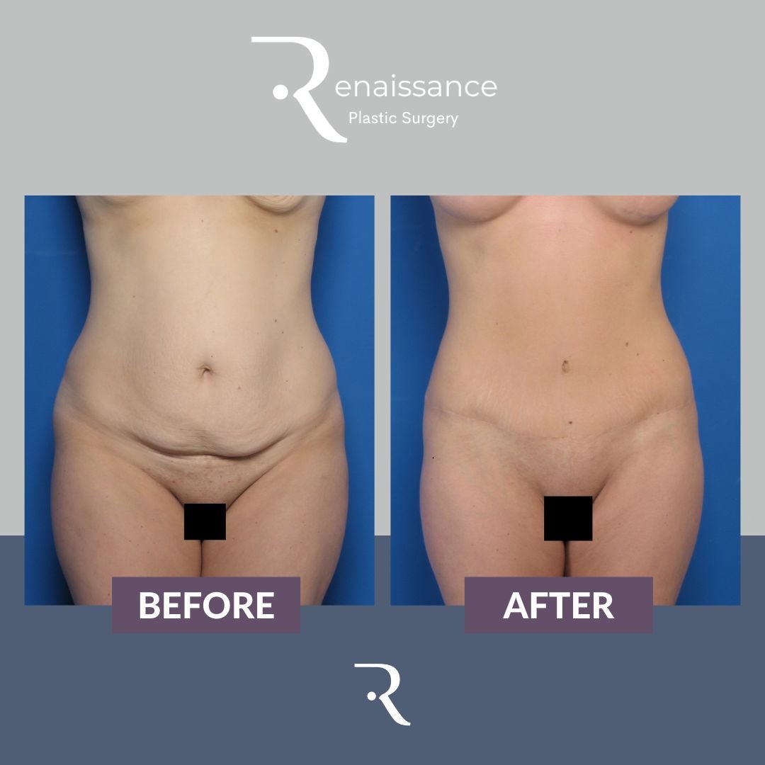 Tummy Tuck Before and After 7 - Front