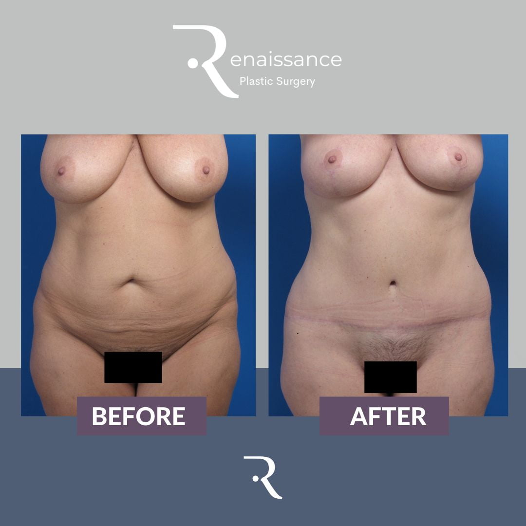 Tummy Tuck Before and After 9 - Front